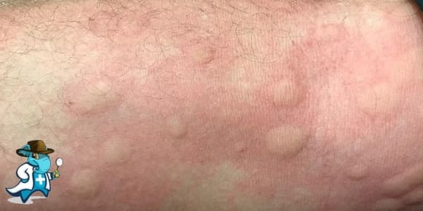 ¿Puedo Ocultar que Tengo Toxicodermias para Contratar el Seguro Médico en España?