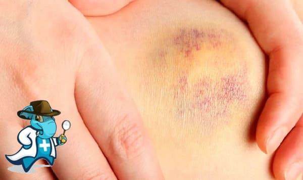 ¿Puedo Ocultar que Tengo Trombocitopenia Inmune Primaria Para Contratar el Seguro Médico en España?