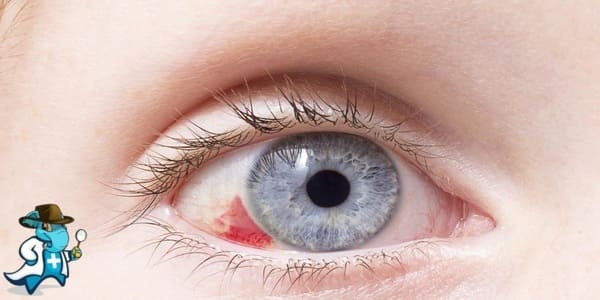 ¿Puedo Ocultar que Tengo un Derrame Ocular para Contratar el Seguro Médico en España?