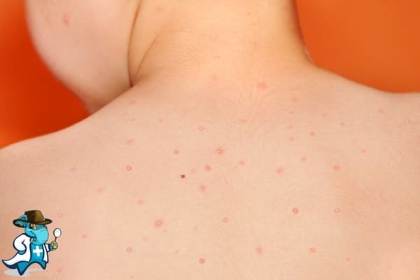 ¿Qué Exclusiones Tendría un Seguro Médico para una Persona con Molusco Contagioso en España?