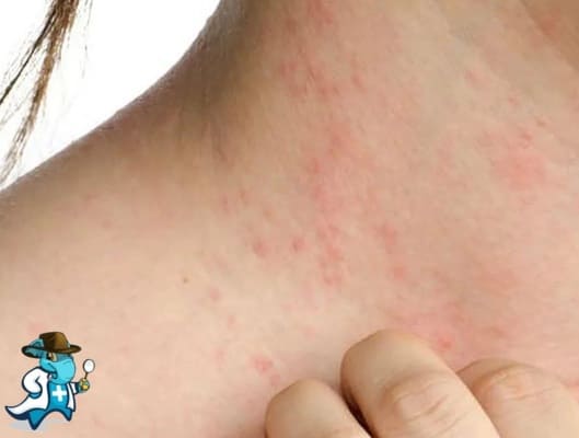 ¿Qué Exclusiones Tendría un Seguro Médico para una Persona con una Alergia Atópica en España?