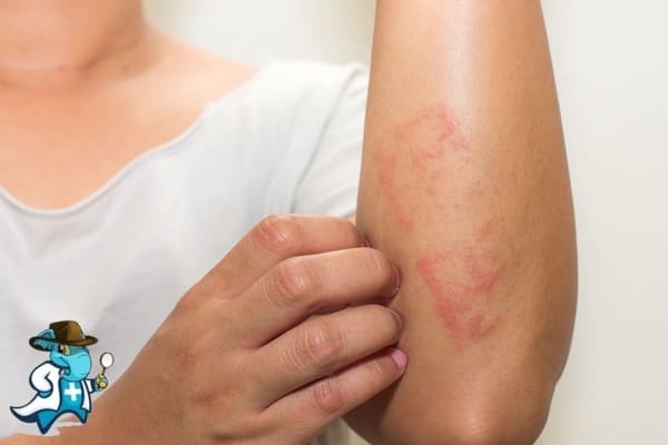 ¿Qué Exclusiones Tendría un Seguro Médico para una Persona con una Dermatitis Atópica en España?