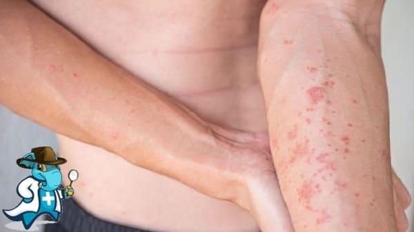 ¿Aumenta el Precio del Seguro Médico Para una Persona con Eczema en España?