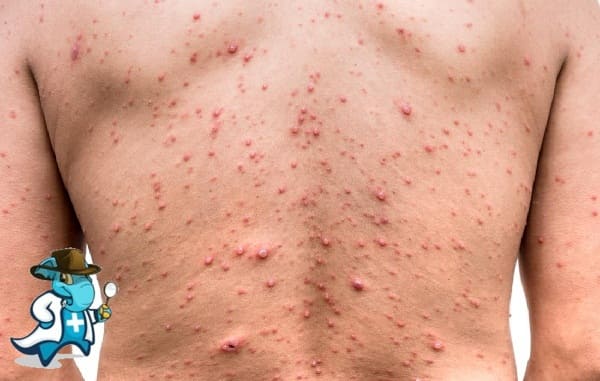 ¿Aumenta el Precio del Seguro Médico Para una Persona con Varicela en España?