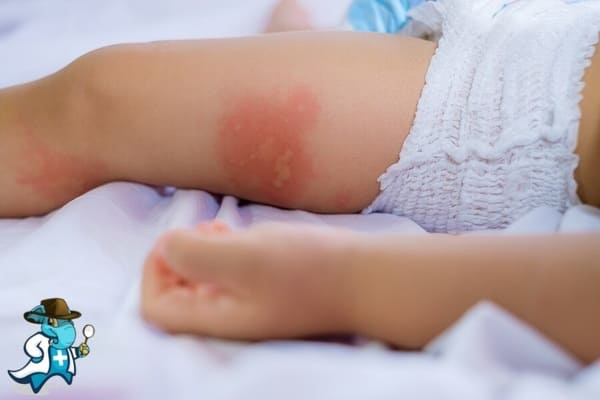 ¿Cuánto Cuesta el Seguro Médico que Cubra la Dermatitis del Pañal en España?