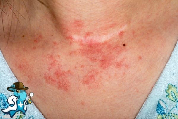 ¿Cubre el Seguro Médico el Eczema en España?