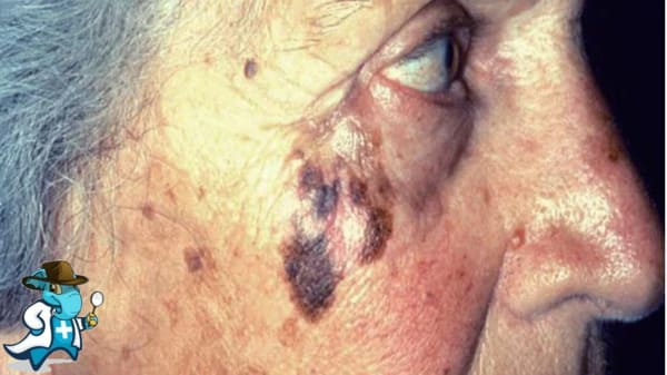 ¿Cubre el Seguro Médico el Léntigo en España?