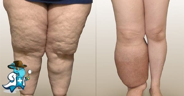¿Cubre el Seguro Médico el Linfedema en España?