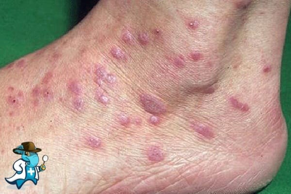 ¿Cubre el Seguro Médico el Liquen Plano en España?