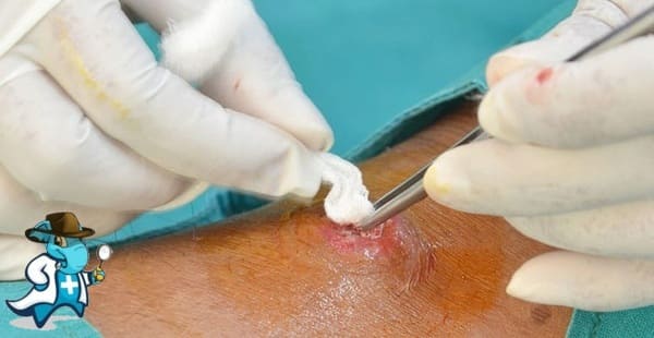 ¿Cubre el Seguro Médico el Quiste Pilonidal en España?