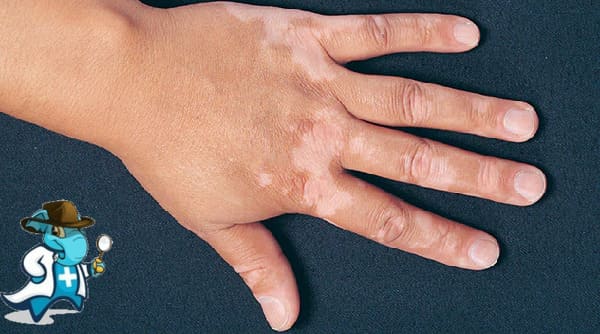 ¿Cubre el Seguro Médico el Vitiligo en España?