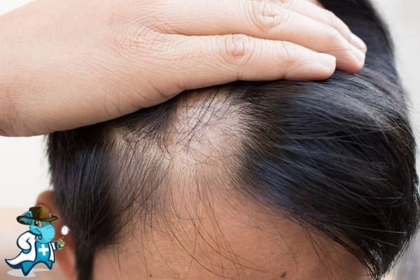 ¿Cubre el Seguro Médico la Alopecia Areata en España?