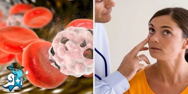 ¿Cubre el Seguro Médico la Anemia Perniciosa en España?