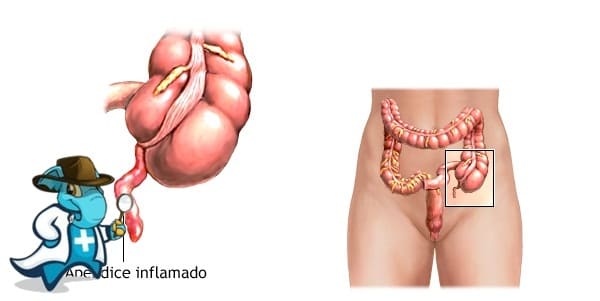 ¿Cubre el Seguro Médico la Apendicitis en España?