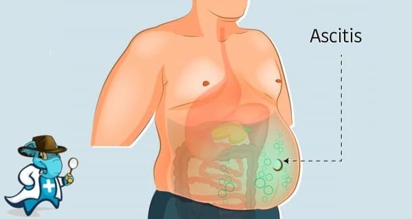 ¿Cubre el Seguro Médico la Ascitis en España?