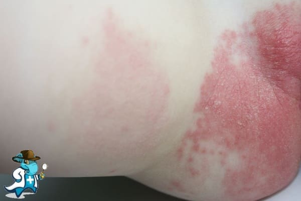 ¿Cubre el Seguro Médico la Dermatitis del Pañal en España?
