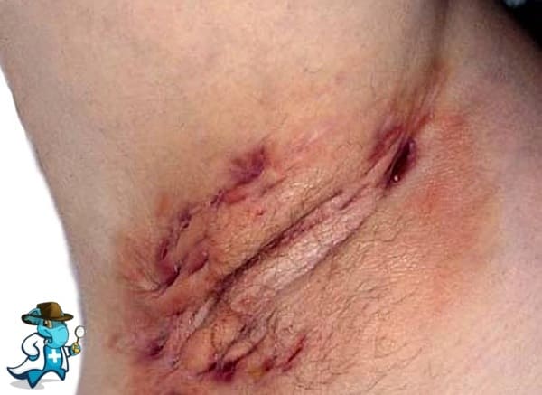 ¿Cubre el Seguro Médico la Hidradenitis Supurativa en España?