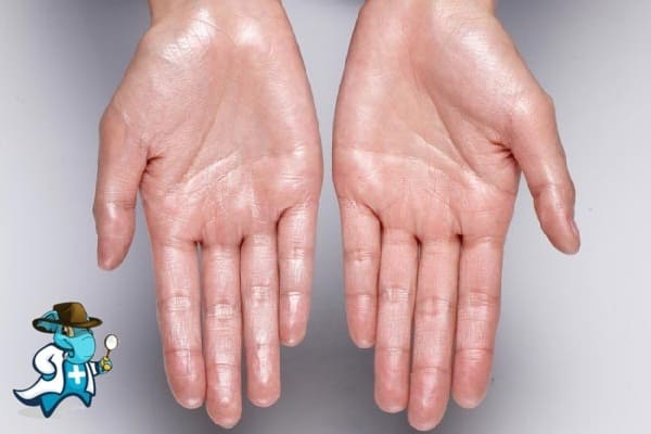 ¿Cubre el Seguro Médico la Hiperhidrosis en España?