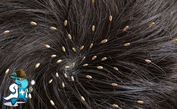 ¿Cubre el Seguro Médico la Pediculosis General en España?