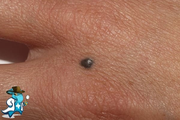 ¿Cubre el Seguro Médico los Nevus en España?