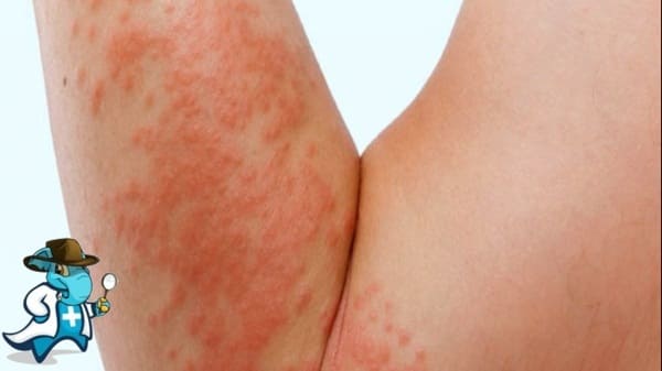 ¿Cubre el Seguro Médico la Sarna o Escabiosis en España?