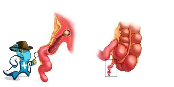 ¿Puedo Ocultar que Tengo Apendicitis Para Contratar el Seguro Médico en España?