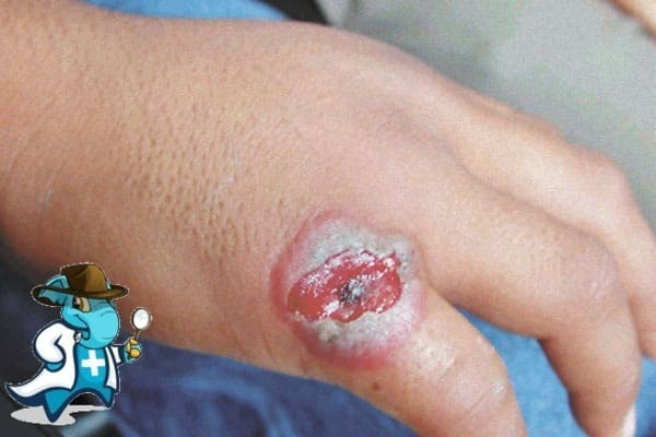 ¿Puedo Contratar un Seguro Médico si Tengo Carbunco en España?