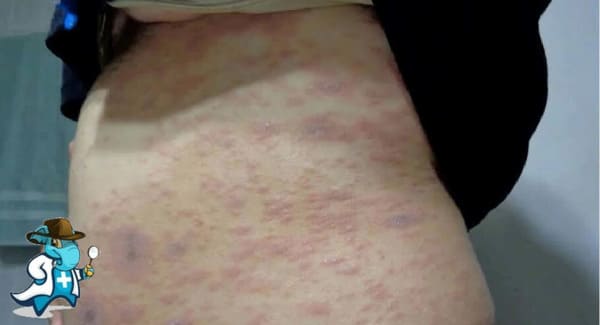 ¿Puedo Contratar un Seguro Médico si Tengo Liquen Plano en España?