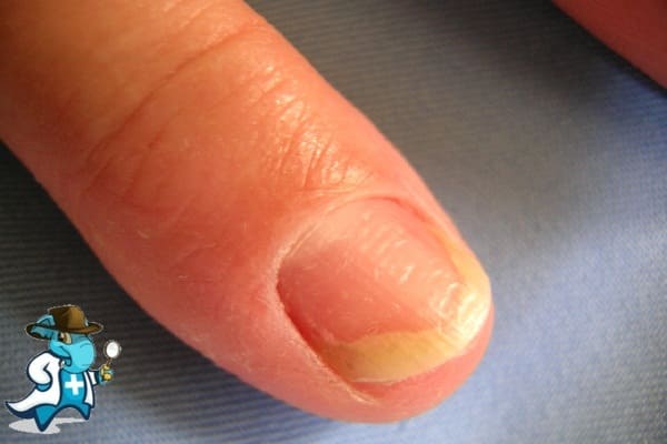 ¿Puedo Ocultar que Tengo Onicomicosis Para Contratar el Seguro Médico en España?
