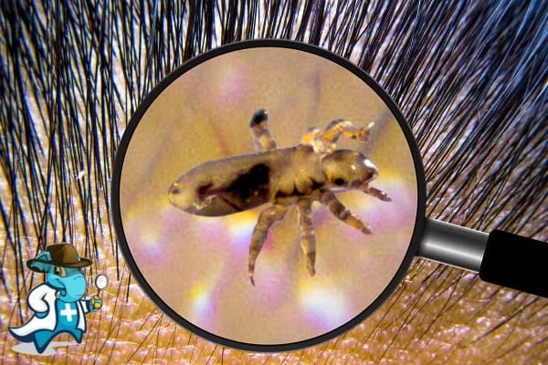 ¿Puedo Contratar un Seguro Médico si Tengo Pediculosis General en España?