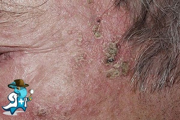 ¿Puedo Contratar un Seguro Médico si Tengo Queratosis Actínica en España?