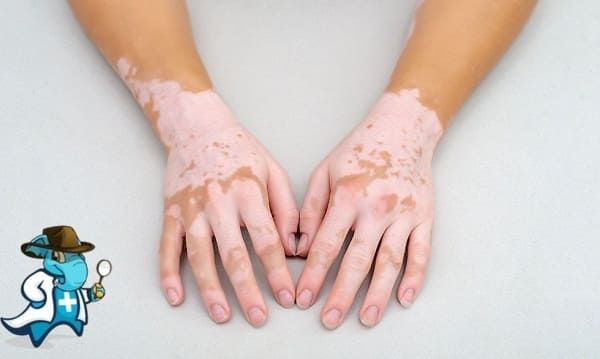 ¿Puedo Contratar un Seguro Médico si Tengo Vitiligo en España?