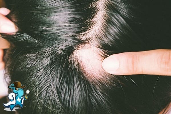¿Puedo Contratar un Seguro Médico si Tengo la Alopecia Areata en España?