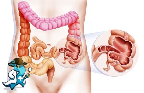 ¿Puedo Ocultar que Tengo Apendicitis Para Contratar el Seguro Médico en España?