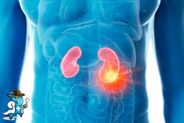 ¿Puedo Ocultar que Tengo Cáncer de Riñón para Contratar el Seguro Médico en España?