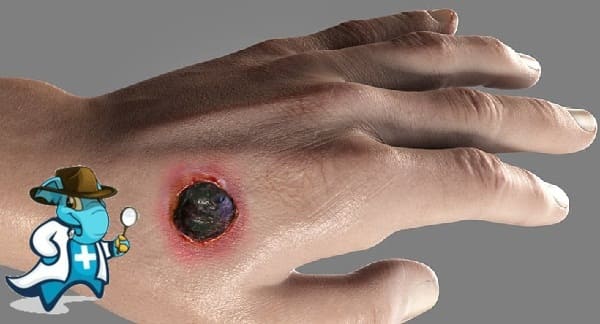¿Puedo Ocultar que Tengo Carbunco Para Contratar el Seguro Médico en España?