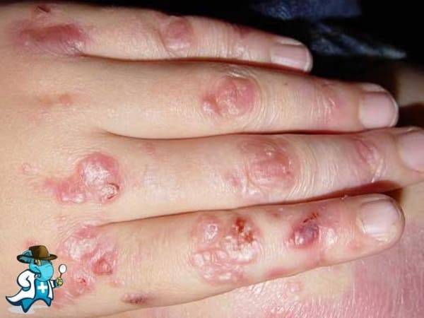 ¿Puedo Ocultar que Tengo Epidermólisis Bullosa Para Contratar el Seguro Médico en España?