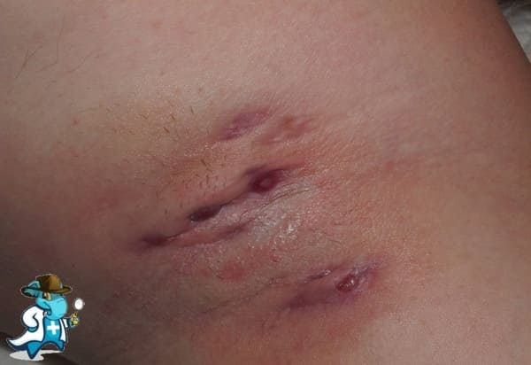 ¿Puedo Ocultar que Tengo Hidradenitis Supurativa Para Contratar el Seguro Médico en España?