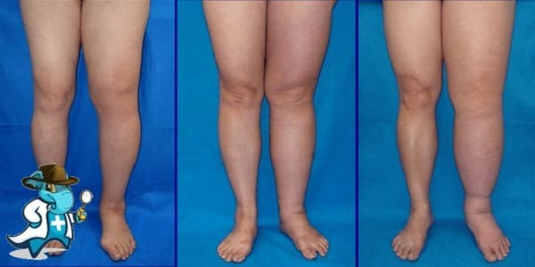 ¿Puedo Ocultar que Tengo Linfedema Para Contratar el Seguro Médico en España?