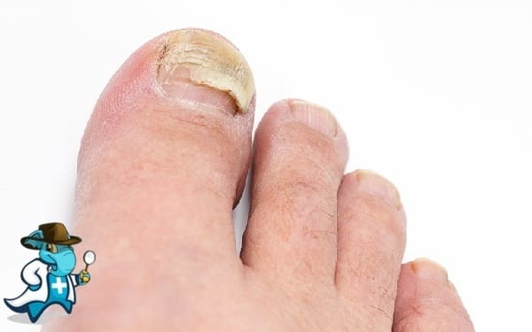 ¿Puedo Contratar un Seguro Médico si Tengo Onicomicosis en España?
