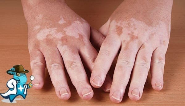 ¿Puedo Ocultar que Tengo el Vitiligo Para Contratar el Seguro Médico en España?