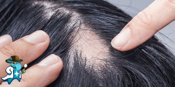 ¿Puedo Ocultar que Tengo la Alopecia Areata para Contratar el Seguro Médico en España?