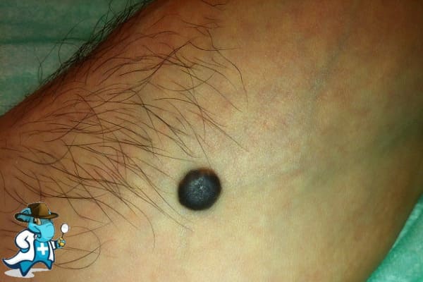 ¿Qué Exclusiones Tendría un Seguro Médico Para una Persona con Nevus en España?