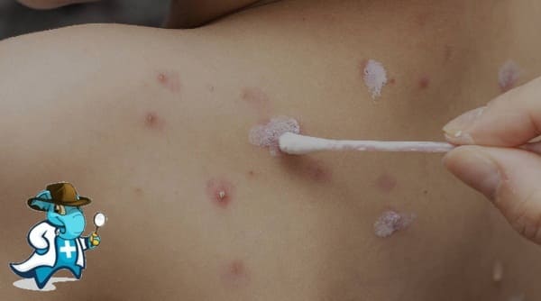 ¿Qué Exclusiones Tendría un Seguro Médico Para una Persona con Varicela en España?