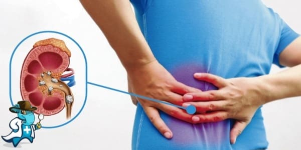 ¿Puedo Ocultar que Tengo Cólico Nefrítico para Contratar el Seguro Médico en España?