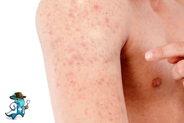 ¿Aumenta el Precio del Seguro Médico para una Persona con una Alergia a las Avellanas en España?