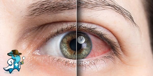 ¿Cubre el Seguro Médico el Ojo Seco España?