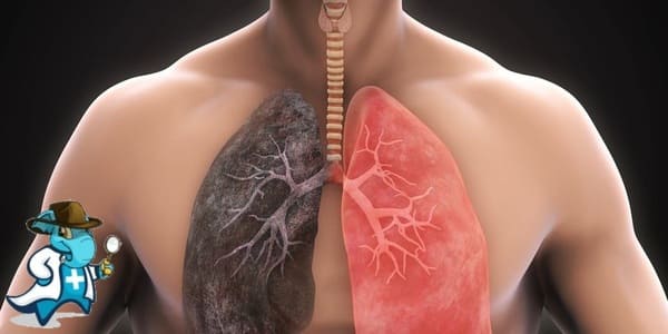 ¿Cubre el Seguro Médico la Asbestosis en España?
