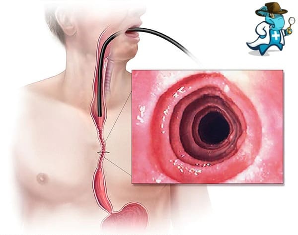 ¿Cubre el Seguro Médico la Esofagitis Eosinofílica en España?