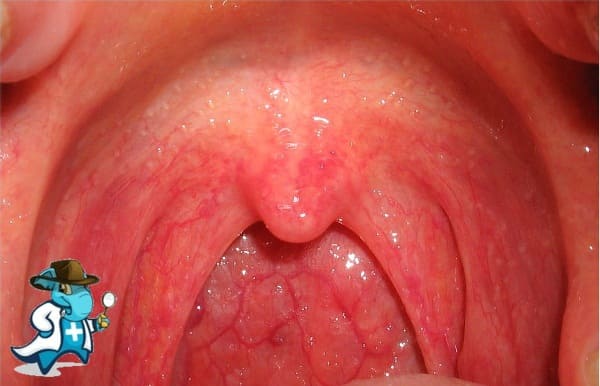 ¿Cubre el Seguro Médico la Faringitis en España?